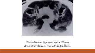 Bilateral traumatic pneumatoceles. CT scan
demonstrates bilateral cysts with air-fluid levels.
 