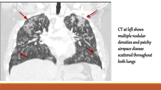 CT at left shows
multiplenodular
densities and patchy
airspace disease
scatteredthroughout
both lungs
 