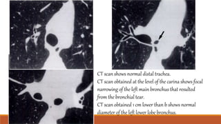 CT scan shows normal distal trachea.
CT scan obtained at the level of the carina shows focal
narrowing of the left main bronchus that resulted
from the bronchial tear.
CT scan obtained 1 cm lower than b shows normal
diameter of the left lower lobe bronchus.
 