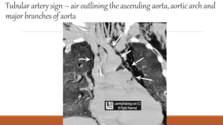 Tubulararterysign – airoutliningthe ascendingaorta,aorticarchand
majorbranches of aorta
 