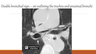 Double bronchialsign – airoutlining thetracheaandproximalbronchi
 