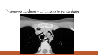 Pneumopericardium– air anteriorto pericardium
 