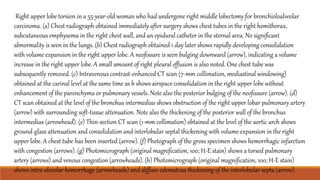 Right upper lobe torsion in a 55-year-old woman who had undergone right middle lobectomy for bronchioloalveolar
carcinoma. (a) Chest radiograph obtained immediately after surgery shows chest tubes in the right hemithorax,
subcutaneous emphysema in the right chest wall, and an epidural catheter in the sternal area. No signiﬁcant
abnormality is seen in the lungs. (b) Chest radiograph obtained 1 day later shows rapidly developing consolidation
with volume expansion in the right upper lobe. A neoﬁssure is seen bulging downward (arrow), indicating a volume
increase in the right upper lobe. A small amount of right pleural effusion is also noted. One chest tube was
subsequently removed. (c) Intravenous contrast-enhanced CT scan (7-mm collimation, mediastinal windowing)
obtained at the carinal level at the same time as b shows airspace consolidation in the right upper lobe without
enhancement of the parenchyma or pulmonary vessels. Note also the posterior bulging of the neoﬁssure (arrow). (d)
CT scan obtained at the level of the bronchus intermedius shows obstruction of the right upper lobar pulmonary artery
(arrow) with surrounding soft-tissue attenuation. Note also the thickening of the posterior wall of the bronchus
intermedius (arrowhead). (e) Thin-section CT scan (1-mm collimation) obtained at the level of the aortic arch shows
ground-glass attenuation and consolidation and interlobular septal thickening with volume expansion in the right
upper lobe. A chest tube has been inserted (arrow). (f) Photograph of the gross specimen shows hemorrhagic infarction
with congestion (arrows). (g) Photomicrograph (original magniﬁcation, 100; H-E stain) shows a torsed pulmonary
artery (arrows) and venous congestion (arrowheads). (h) Photomicrograph (original magniﬁcation, 100; H-E stain)
shows intra-alveolar hemorrhage (arrowheads) and diffuse edematous thickening of the interlobular septa (arrow).
 