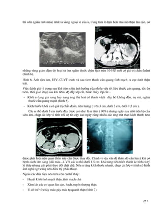 257
th× sím (giµu t−íi m¸u) nhÊt lµ vïng ngo¹i vi cña u, trung t©m Ýt ®Ëm h¬n nhu m« thËn l©n cËn, cã
nh÷ng vïng gi¶m ®Ëm do ho¹i tö (sù ngÊm thuèc chªn lÖch trªn 10 HU míi cã gi¸ trÞ chÈn ®o¸n)
(h×nh 6).
H×nh 6. ¶nh siªu ©m, UIV, CLVT tr−íc vµ sau tiªm thuèc c¶n quang tÜnh m¹ch u cùc d−íi thËn
tr¸i.
ViÖc ®¸nh gi¸ tû träng sau khi tiªm chÞu ¶nh h−ëng cña nhiÒu yÕu tè: liÒu thuèc c¶n quang, tèc ®é
tiªm, thêi gian chôp sau khi tiªm, ®é dÇy líp c¾t, b−íc nh¶y líp c¾t...
- Khèi u d¹ng gi¶ nang hay nang ung th− ho¸ cã thµnh v¸ch dÇy bê kh«ng ®Òu, nô sïi, ngÊm
thuèc c¶n quang m¹nh (h×nh 8).
- KÝch th−íc khèi u cã gi¸ trÞ chÈn ®o¸n, tiªn l−îng ( trªn 3 cm, d−íi 3 cm, d−íi 1,5 cm ).
C¸c u nhá d−íi 3 cm tr−íc ®©y ®−îc coi nh− lµ u lµnh ( 90%) nh−ng ngµy nay nhê tiÕn bé cña
siªu ©m, chôp c¾t líp vi tÝnh víi ®é tin cËy cao ngµy cµng nhiÒu c¸c ung th− thËn kÝch th−íc nhá
®ùoc ph¸t hiÖn nªn quan ®iÓm nµy cÇn ®−îc thay ®æi. ChÝnh v× vËy vÊn ®Ò th¨m dß cÇn l−u ý khi cã
bÖnh c¶nh l©m sµng (®¸i m¸u...). Víi c¸c u nhá d−íi 1,5 cm kh¶ n¨ng tiÕn triÓn thµnh ¸c tÝnh cã tû
lÖ thÊp nh−ng cÇn ph¶i theo dâi chÆt chÏ. NÕu u t¨ng kÝch th−íc nhanh, chôp c¾t líp vi tÝnh cã h×nh
¶nh nghi ngê còng nªn ®iÒu trÞ phÉu thuËt.
Ngoµi c¸c dÊu hiÖu nªu trªn cßn cã thÓ thÊy:
- HuyÕt khèi tÜnh m¹ch thËn, tÜnh m¹ch chñ
- X©m lÊn c¸c c¬ quan l©n cËn, h¹ch, tuyÕn th−îng thËn.
- U cã thÓ vì ch¶y m¸u g©y m¸u tô quanh thËn (h×nh 7).
 