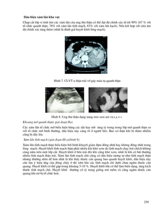 258
DÊu hiÖu x©m lÊn khu vùc
Chôp c¾t líp vi tÝnh t×m c¸c x©m lÊn cña ung th− thËn cã thÓ ®¹t ®é chÝnh x¸c tõ tíi 90% (67 % víi
tæ chøc quanh thËn, 78% víi x©m lÊn tÜnh m¹ch, 83% víi x©m lÊn h¹ch). NÕu kÕt hîp víi siªu ©m
®é chÝnh x¸c t¨ng thªm (nhÊt lµ ®¸nh gi¸ huyÕt khèi lßng m¹ch).
H×nh 7. CLVT u thËn tr¸i vì g©y m¸u tô quanh thËn
H×nh 8. Ung th− thËn d¹ng nang trªn siªu ©m vµ CLVT
Khoang mì quanh thËn( giai ®o¹n IIa)
C¸c x©m lÊn tæ chøc mì biÓu hiÖn b»ng c¸c d¶i hay nèt t¨ng tû träng trong líp mì quanh thËn so
víi tæ chøc mì b×nh th−êng, dÊu hiÖu nµy cµng râ ë ng−êi bÐo. Bao x¬ thËn khi bÞ th©m nhiÔm
còng bÞ dÇy lªn.
X©m lÊn tÜnh m¹ch (giai ®o¹n III a)(h×nh 9)
X©m lÊn tÜnh m¹ch thËn biÓu hiÖn bëi h×nh khuyÕt gi¶m ®Ëm ®ång nhÊt hay kh«ng ®ång nhÊt trong
lßng m¹ch. HuyÕt khèi tÜnh m¹ch thËn ph¶i nhiÒu khi khã xem do tÜnh m¹ch ch¹y h¬i chÕch kh«ng
cïng n»m trªn mét líp c¾t. HuyÕt khèi ë bªn tr¸i ®«i khi còng khã xem, nhÊt lµ khi cã bÊt th−êng
nhiÒu tÜnh m¹ch thËn tr¸i. X©m lÊn tÜnh m¹ch chñ còng cã dÊu hiÖu t−¬ng tù nh− tÜnh m¹ch thËn
nh−ng th−êng nh×n dÔ h¬n nhÊt lµ khi thÊy thuèc c¶n quang bao quanh huyÕt khèi, dÊu hiÖu nµy
cÇn l−u ý hiÖu øng cña dßng ch¶y ë th× sím khi c¸c tÜnh m¹ch chi d−íi ch−a ngÊm thuèc c¶n
quang. HuyÕt khèi cã thÓ gÆp trong kho¶ng 5-10 %. HuyÕt khèi lín cã thÓ lµm biÕn d¹ng, t¨ng kÝch
th−íc tÜnh m¹ch chñ. HuyÕt khèi th−êng cã tû träng gièng m« mÒm vµ còng ngÊm thuèc c¶n
quang khi nã bÞ tæ chøc ho¸.
 