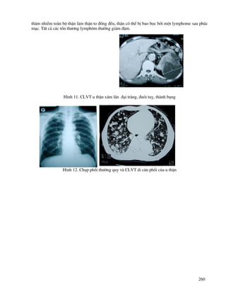 260
th©m nhiÔm toµn bé thËn lµm thËn to ®ång ®Òu, thËn cã thÓ bÞ bao bäc bëi mét lymphome sau phóc
m¹c. TÊt c¶ c¸c tæn th−¬ng lymph«m th−êng gi¶m ®Ëm.
H×nh 11. CLVT u thËn x©m lÊn ®¹i trµng, ®u«i tuþ, thµnh bông
H×nh 12. Chôp phæi th−êng quy vµ CLVT di c¨n phæi cña u thËn
 