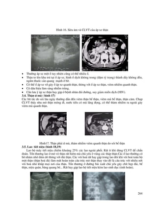 264
H×nh 16. Siªu ©m vµ CLVT cña ¸p xe thËn
• Th−êng ¸p xe mét æ tuy nhiªn còng cã thÓ nhiÒu æ.
• ThËn to lªn khu tró t¹i æ ¸p xe, h×nh æ dÞch kh«ng trong (®Ëm tû träng) thµnh dÇy kh«ng ®Òu,
ngÊm thuèc c¶n quang m¹nh ë bê.
• Cã thÓ æ ¸p xe vì g©y æ ¸p xe quanh thËn, th«ng víi æ ¸p xe thËn, viªm nhiÔm quanh thËn.
• Cã dÊu hiÖu l©m sµng nhiÔm trïng.
• CÇn l−u ý ¸p xe thËn hay gÆp ë bÖnh nh©n ®¸i ®−êng, suy gi¶m miÔn dÞch (HIV).
3.4. ThËn ø mñ ( h×nh 17)
C¸c bÝt t¾c do sái l©u ngµy th−êng dÉn ®Õn viªm thËn bÓ thËn, viªm mñ bÓ thËn, thËn c©m. Chôp
CLVT thÊy nhu m« thËn máng ®i, n−íc tiÓu cã mñ l¾ng ®äng, cã thÓ th©m nhiÔm ra ngoµi g©y
viªm mñ quanh thËn.
H×nh17. ThËn ph¶i ø mñ, th©m nhiÔm viªm quanh thËn do sái bÓ thËn
3.5. Lao tiÕt niÖu (h×nh 18,19)
Lao bé m¸y tiÕt niÖu chiÕm kho¶ng 25% c¸c lao ngoµi phæi. RÊt Ýt khi dïng CLVT ®Ó chÈn
®o¸n. Tæn th−¬ng lao ë m« vá thËn rÊt hiÕm mµ chñ yÕu ë vïng c¸c th¸p thËn.C¸c æ lao th−êng cã
bê nh©m nhë dóm dã th«ng víi ®µi thËn. C¸c v«i ho¸ rÊt hay gÆp trong lao ®«i khi v«i ho¸ toµn bé
mét thËn (thËn ho¸ ®¸) lµm mÊt hoµn toµn cÊu tróc m« thËn thay vµo ®ã lµ cÊu tróc víi nhiÒu nèt
v«i ho¸ nhá kh¾p mäi n¬i cña thËn. Tæn th−¬ng ë ®−êng bµi xuÊt chñ yÕu g©y chÝt hÑp ®µi, bÓ
thËn, niÖu qu¶n, bµng quang bÐ... RÊt hay gÆp lao hÖ tiÕt niÖu kÌm lao sinh dôc (tinh hoµn).
 
