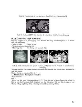 265
H×nh18. ThËn tr¸i ho¸ ®¸ trªn siªu ©m vµ chôp hÖ tiÕt niÖu kh«ng chuÈn bÞ
H×nh 19. H×nh ¶nh CLVT thËn ph¶i ho¸ ®¸ tr−íc vµ sau khi tiªm thuèc c¶n quang
IV. ChÊn th−¬ng thËn (h×nh 20,21)
HiÖn nay chôp CLVT lµ ph−¬ng ph¸p chÈn ®o¸n tèt nhÊt trong chÊn th−¬ng thËn, ta cã thÓ x¸c
®Þnh tõng tæn th−¬ng:
- M¶nh vì thËn - §−êng vì thËn
- Tæn th−¬ng m¹ch m¸u cuèng thËn
- Chøc n¨ng thËn - Tæn th−¬ng m¸u tô quanh thËn
H×nh 20. H×nh ¶nh siªu ©m m¸u tô d−íi bao thËn, vì thËn tr¸i trªn CLVT tr−íc vµ sau tiªm thuèc
c¶n quang
Tói n−íc tiÓu h×nh æ dÞch n−íc tiÓu hay tËp trung ë phÇn thÊp rèn thËn, cã thÓ th«ng víi ®−êng bµi
xuÊt hoÆc kh«ng.
C¸c tæn th−¬ng c¬ quan kh¸c kÌm theo
4.1. Ph©n lo¹i chÊn th−¬ng thËn ( h×nh 21b)
Theo Chatelain:
Lo¹i I:
Th−êng gÆp nhÊt trong chÊn th−¬ng thËn ( 85%): §ông dËp nhu m« thËn (æ ®ông dËp) cã thÓ cã
kÌm tô m¸u d−íi bao thËn, h×nh d¸ng thËn hÇu nh− kh«ng thay ®æi, bao thËn cßnnguyªn vÑn.
Th−êng æ ®ông dËp kh«ng th«ng víi ®−êng bµi xuÊt hoÆc cã th«ng kh«ng
 