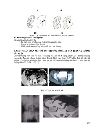 267
I II
III IV
H×nh 21 b. H×nh minh ho¹ ph©n lo¹i c¸c møc ®é vì thËn
4.2. Di chøng cña chÊn th−¬ng thËn
C¸c di chøng th−êng thÊy lµ:
* Tô dÞch n−íc tiÓu hay gÆp ë vïng thÊp cña rèn thËn.
* C¸c ¸p xe ho¸ sau chÊn th−¬ng
* Ph×nh m¹ch, th«ng ®éng tÜnh m¹ch sau chÊn th−¬ng...
V. CLVT chÈn ®o¸n mét sè bÊt th−êng bÈm sinh cña thËn vμ ®−êng
bμi xuÊt
C¸c bÊt th−êng bÈm sinh cña thËn vµ ®−êng bµi xuÊt rÊt ®a d¹ng, chôp CLVT lµ mét ph−¬ng
ph¸p chÈn ®o¸n tèt nh−ng Ýt ®−îc dïng do gi¸ thµnh cao. Chôp CLVT chÈn ®o¸n tèt c¸c bÊt
th−êng vÒ sè l−îng, vÞ trÝ cña thËn ( thËn sa, l¹c chç), thËn dÝnh nhau, c¸c bÖnh lý trªn thËn bÊt
th−êng (h×nh 22,23,24,25,26 27).
H×nh 22.ThËn ®«i trªn CLVT
 