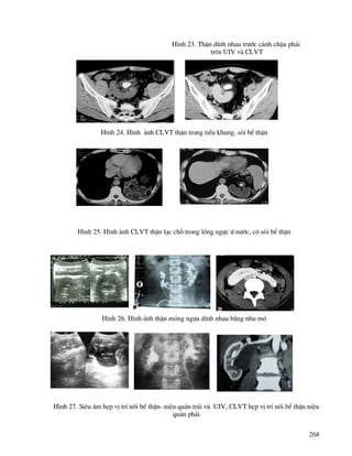 268
H×nh 23. ThËn dÝnh nhau tr−íc c¸nh chËu ph¶i
trªn UIV vµ CLVT
H×nh 24. H×nh ¶nh CLVT thËn trong tiÓu khung, sái bÓ thËn
H×nh 25. H×nh ¶nh CLVT thËn l¹c chç trong lång ngùc ø n−íc, cã sái bÓ thËn
H×nh 26. H×nh ¶nh thËn mãng ngùa dÝnh nhau b»ng nhu m«
H×nh 27. Siªu ©m hÑp vÞ trÝ nèi bÓ thËn- niÖu qu¶n tr¸i vµ UIV, CLVT hÑp vÞ trÝ nèi bÓ thËn niÖu
qu¶n ph¶i
 