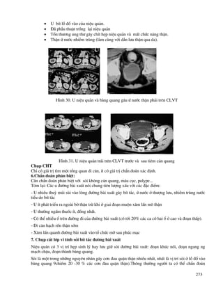 273
• U bÝt lç ®æ vµo cña niÖu qu¶n.
• §· phÉu thuËt trång l¹i niÖu qu¶n
• Tæn th−¬ng ung th− g©y chÝt hÑp niÖu qu¶n vµ mÊt chøc n¨ng thËn.
• ThËn ø n−íc nhiÔm trïng (lµm cïng víi dÉn l−u thËn qua da).
H×nh 30. U niÖu qu¶n vµ bµng quang g©u ø n−íc thËn ph¶i trªn CLVT
H×nh 31. U niÖu qu¶n tr¸i trªn CLVT tr−íc vµ sau tiªm c¶n quang
Chôp CHT
ChØ cã gi¸ trÞ t×m mét tæng quan di c¨n, Ýt cã gi¸ trÞ chÈn ®o¸n x¸c ®Þnh.
6.ChÈn ®o¸n ph©n biÖt:
CÇn chÈn ®o¸n ph©n biÖt víi sái kh«ng c¶n quang, m¸u côc, polype...
Tãm l¹i: C¸c u ®−êng bµi xuÊt nãi chung tiªn l−îng xÊu víi c¸c ®Æc ®iÓm:
- U nhiÒu thuú mói sïi vµo lßng ®−êng bµi xuÊt g©y bÝt t¾c, ø n−íc ë th−îng l−u, nhiÔm trïng n−íc
tiÓu do bÝt t¾c
- U Ýt ph¸t triÓn ra ngoµi bê thËn trõ khi ë giai ®o¹n muén x©m lÊn m« thËn
- U th−êng ngÊm thuèc Ýt, ®ång nhÊt.
- Cã thÓ nhiÒu æ trªn ®−êng ®i cña ®−êng bµi xuÊt (cã tíi 20% c¸c ca cã hai æ ë cao vµ ®o¹n thÊp).
- Di c¨n h¹ch rèn thËn sím
- X©m lÊn quanh ®−êng bµi xuÊt vµo tæ chøc mì sau phóc m¹c
7. Chôp c¾t líp vi tÝnh sái bÝt t¾c ®−êng bµi xuÊt
NiÖu qu¶n cã 3 vÞ trÝ hÑp sinh lý hay l−u gi÷ sái ®−êng bµi xuÊt: ®o¹n khóc nèi, ®o¹n ngang ng
m¹ch chËu, ®o¹n thµnh bµng quang.
Sái lµ mét trong nh÷ng nguyªn nh©n g©y c¬n ®au quÆn thËn nhiÒu nhÊt, nhÊt lµ vÞ trÝ sái ë lç ®æ vµo
bµng quang 9chiÕm 20 -30 % c¸c c¬n ®au quÆn thËn).Th«ng th−êng ng−êi ta cã thÓ chÈn ®o¸n
 