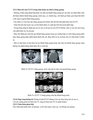 279
2.5.3. H¹n chÕ cña CLVT trong chÈn ®o¸n c¸c khèi u bµng quang
- Kh«ng cã kh¶ n¨ng ph©n biÖt ®−îc c¸c líp cña thµnh bµng quang do vËy khã x¸c ®Þnh ®−îc møc
®é th©m nhiÔm thµnh bµng quang: niªm m¹c, c¬, thanh m¹c, chØ ®¸nh gi¸ ®−îc giai ®o¹n khi khèi
u ®· v−ît ra ngoµi thµnh bµng quang.
- C¸c khèi u ë vßm hay ®¸y bµng quang kÝch th−íc nhá ®«i khi khã ph¸t hiÖn trªn CLVT.
- X©m lÊn tiÒn liÖt tuyÕn x¶y ra trªn bÖnh nh©n cã u ph× ®¹i tiÒn liÖt tuyÕn phèi hîp.
- Trong b¶ng tæng kª ®¸nh gi¸ c¸c di c¨n xa th× gi¸ trÞ cña CLVT kh«ng h¬n so víi siªu ©m trong
viÖc ph¸t hiÖn c¸c di c¨n gan.
- H¹n chÕ ®¸nh gi¸ x©m lÊn qua thµnh bµng quang trong c¸c tr−êng hîp cã viªm bµng quang phèi
hîp, bµng quang ®−îc phÉu thuËt nhiÒu lÇn, ®· ®−îc ®iÒu trÞ tia x¹ hoÆc néi soi chÈn ®o¸n vµ ®iÒu
trÞ.
- Khi cã dÊu hiÖu co kÐo khu tró t¹i thµnh bµng quang hoÆc dµy khu tró thµnh bµng quang còng
kh«ng cho phÐp kh¼ng ®Þnh ®−îc ®· cã x©m lÊn.
H×nh 33. CLVT u bµng quang kÌm x©m lÊn tæ chøc mì quanh bµng quang
H×nh 34. CLVT U bµng quang x©m lÊn thµnh bông tr−íc
2.5.4.Chôp céng h−ëng tõ (T−¬ng tù nh− CLVT nh−ng Ýt tin cËy h¬n trong t×m di c¨n xa
( di c¨n x−¬ng gi¶m tÝn hiÖu trªn T1, t¨ng tÝn hiÖu trªn T2 vµ ngÊm Gado).
2.5.5. ChÈn ®o¸n ph©n biÖt
CÇn chÈn ®o¸n ph©n biÖt víi polype, sa låi niÖu qu¶n, m¸u côc, sái kh«ng c¶n quang...
 