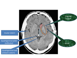 External
                      capsule




   insular cistern



Quadrigeminal plate
    (colliculus)      Insula


 Quadrigeminal and
 ambient cisterns
 