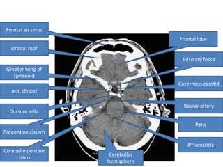 Frontal air sinus
                                   Frontal lobe
   Orbital roof

                                    Pituitary fossa
 Greater wing of
    sphenoid
                                   Cavernous carotid
   Ant. clinoid

                                     Basilar artery
  Dorsum sella

                                          Pons
Prepontine cistern

                                      4th ventricle
Cerebello pontine
                      Cerebellar
     cistern
                     hemisphere
 