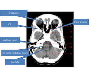 Crista galle



                              Optic foramen
     SOF




Auditory canal




Cerebello medullary fissure



           Medulla
 