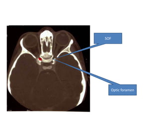 SOF




  Optic foramen
 