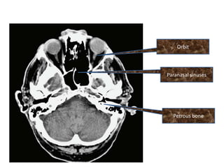 Orbit




Paranasal sinuses




  Petrous bone
 