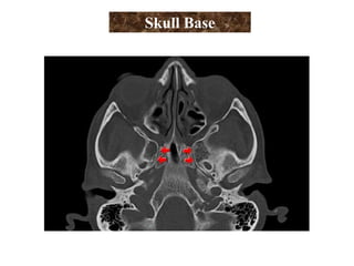 Skull Base
 