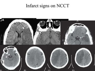 Infarct signs on NCCT




     B            C
 