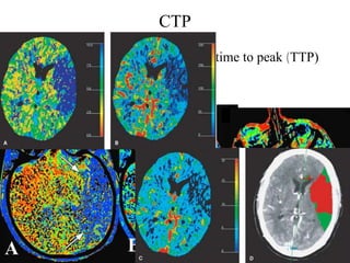 CTP
 1) Mean Transition Time (MTT) or time to peak (TTP)
 2) Cerebral Blood flow (CBF) ,
 3) Cerebral Blood Volume (CBV),




A                   B                  C
 