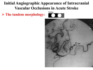 Initial Angiographic Appearance of Intracranial
        Vascular Occlusions in Acute Stroke
 The tandem morphology:
 