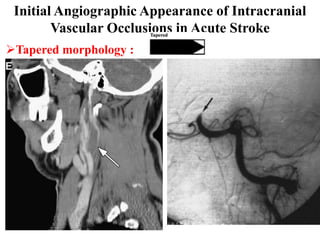 Initial Angiographic Appearance of Intracranial
        Vascular Occlusions in Acute Stroke
Tapered morphology :
 