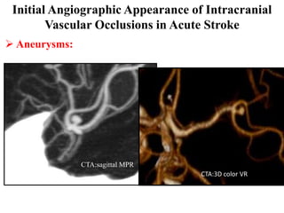 Initial Angiographic Appearance of Intracranial
        Vascular Occlusions in Acute Stroke
 Aneurysms:




               CTA:sagittal MPR
                                   CTA:3D color VR
 
