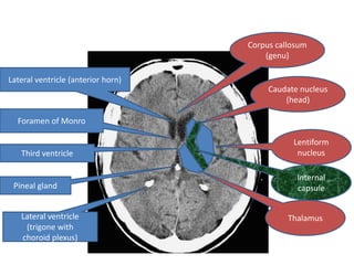 Corpus callosum
                                        (genu)

Lateral ventricle (anterior horn)
                                         Caudate nucleus
                                             (head)

  Foramen of Monro

                                               Lentiform
   Third ventricle                              nucleus

                                                Internal
 Pineal gland                                   capsule


   Lateral ventricle                          Thalamus
    (trigone with
   choroid plexus)
 