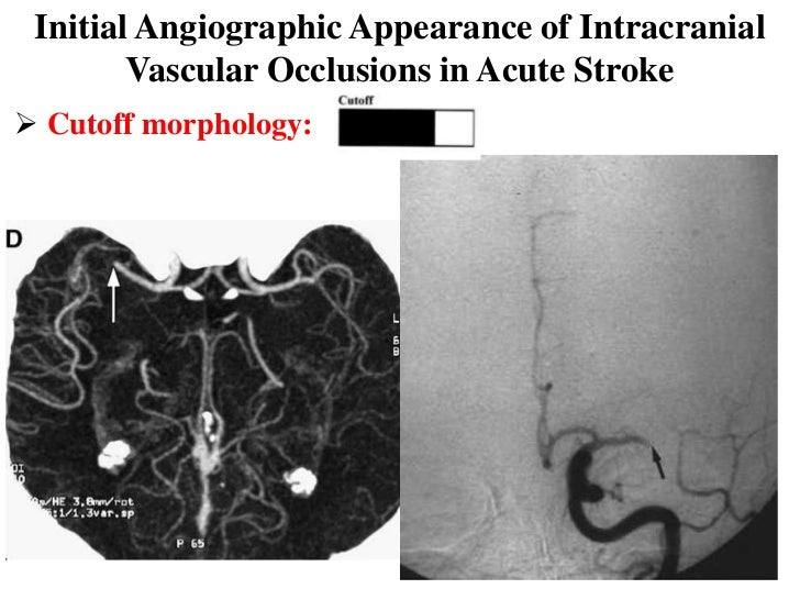 mri of internal auditory canal images which cranial mri of internal auditory canal images which cranial