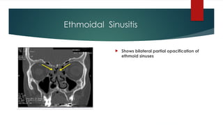 Ethmoidal Sinusitis
 Shows bilateral partial opacification of
ethmoid sinuses
 