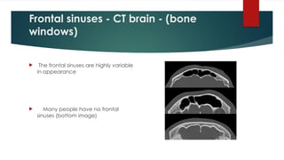 Frontal sinuses - CT brain - (bone
windows)
 The frontal sinuses are highly variable
in appearance
 Many people have no frontal
sinuses (bottom image)
 