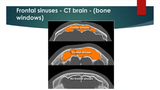 Frontal sinuses - CT brain - (bone
windows)
 