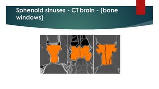 Sphenoid sinuses - CT brain - (bone
windows)
 