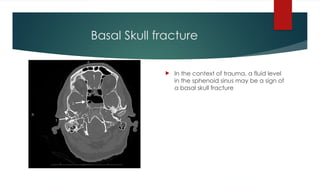 Basal Skull fracture
 In the context of trauma, a fluid level
in the sphenoid sinus may be a sign of
a basal skull fracture
 