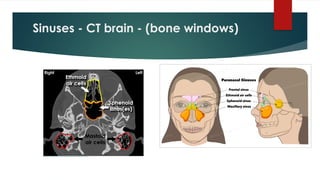 Sinuses - CT brain - (bone windows)
 