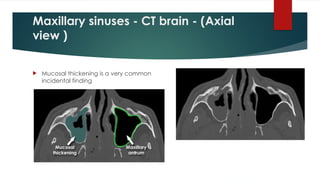 Maxillary sinuses - CT brain - (Axial
view )
 Mucosal thickening is a very common
incidental finding
 
