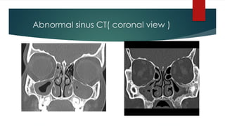 Abnormal sinus CT( coronal view )
 