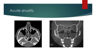 Acute sinusitis
 