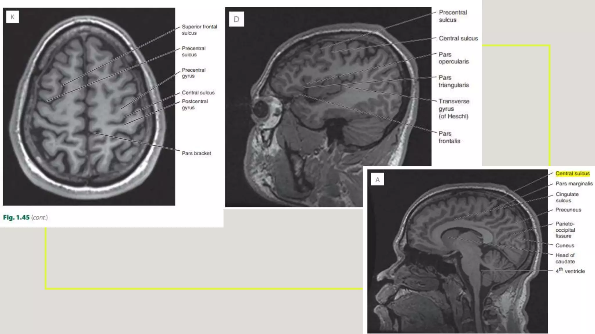 Radiological anatomy of brain.pptx