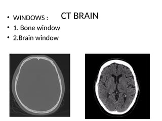 CT scan BRAIN pediatrics for residents.pptx