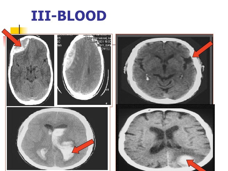 Ct brain basics and anatomy