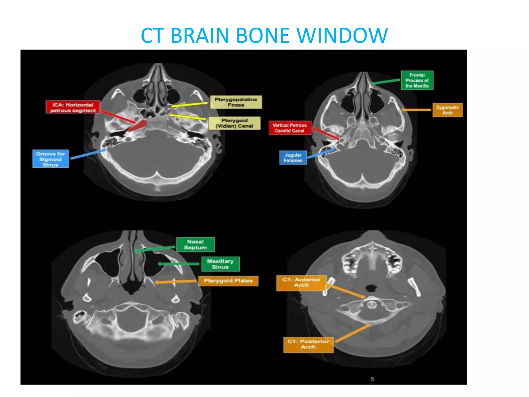 CT BRAIN ANATOMY.pptx