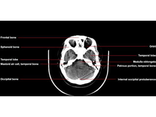 CT Brain Axial.pptx