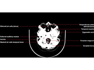 CT Brain Axial.pptx
