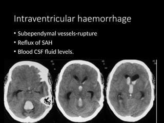 Intraventricular Rupture CT BRAIN IN ACUTE EMERGENCY dr sandra.pptx
