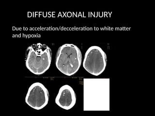 CT BRAIN IN ACUTE EMERGENCY dr sandra.pptx