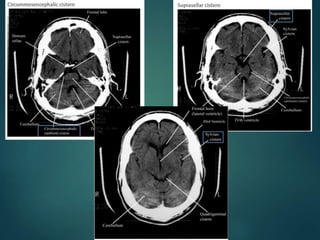 Ct Brain Collimation CT Brain interpretation | PPTX