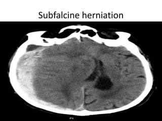 Subfalcine herniation
 