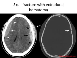 Skull fracture with extradural
hematoma
 