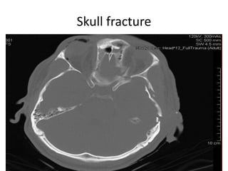 Skull fracture
 